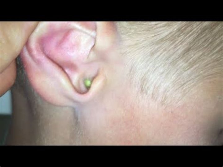Can something get lost in your ear?