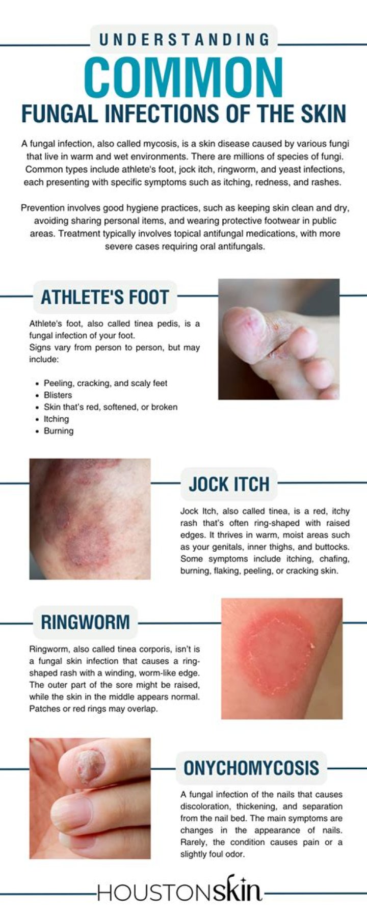 How do you treat a fungal infection on the bottom?