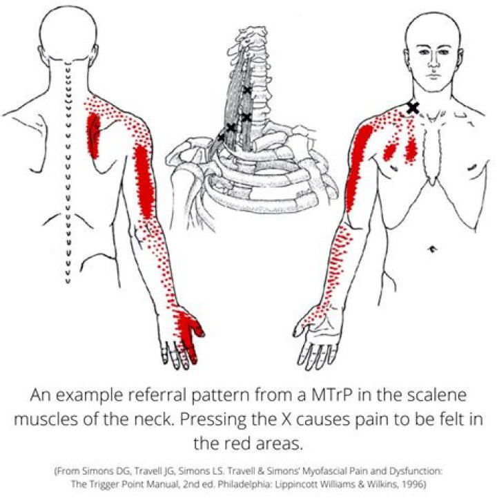Is myofascial pain syndrome permanent?