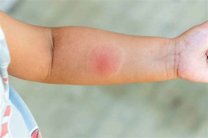 What kind of insect bite leaves a hard lump?